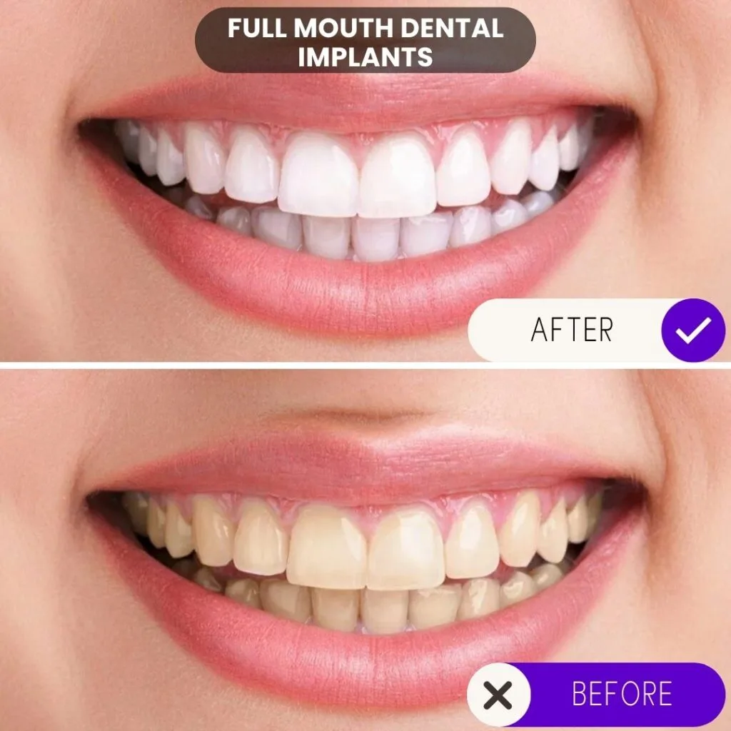 Reemplazo de arco completo con implantes dentales: imágenes antes y después.