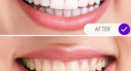 5 razones principales para elegir implantes dentales de boca completa en Turquía