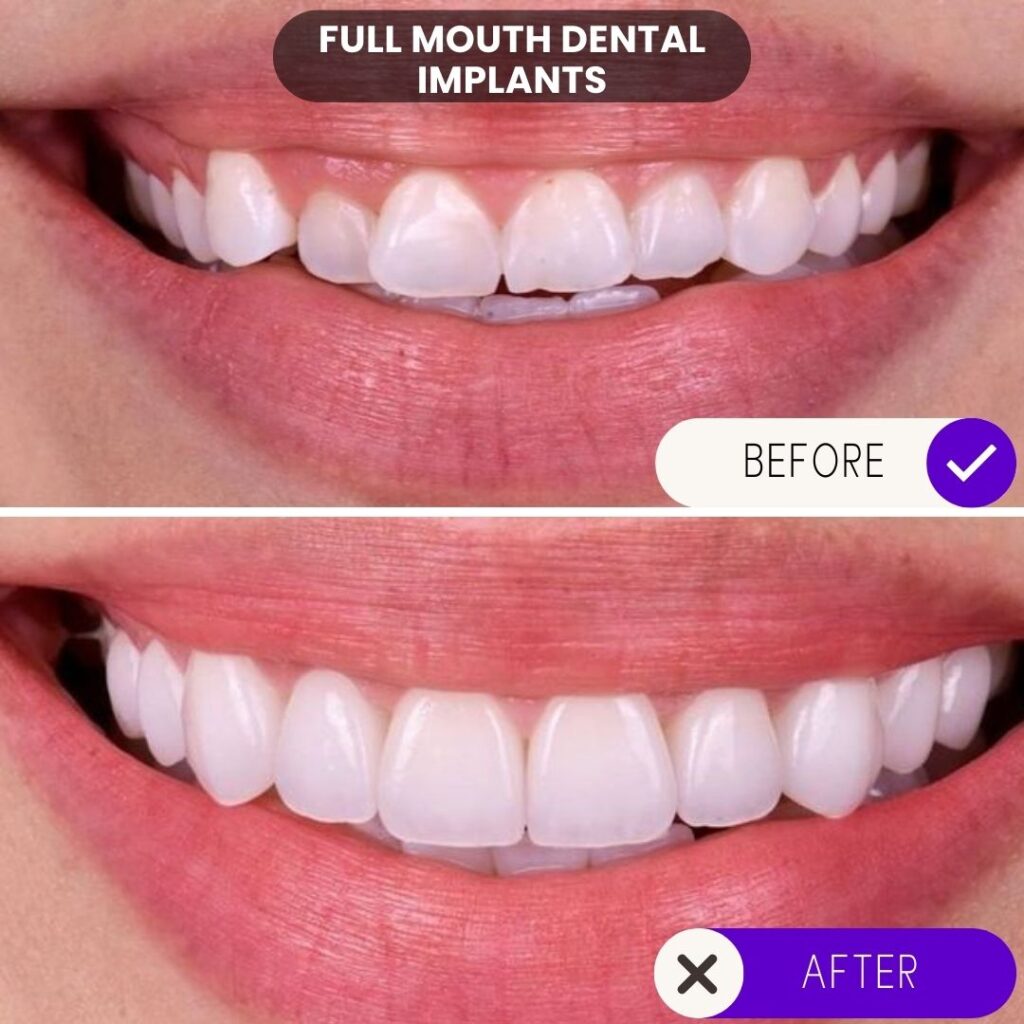 Advanced dental implant results - full mouth reconstruction.