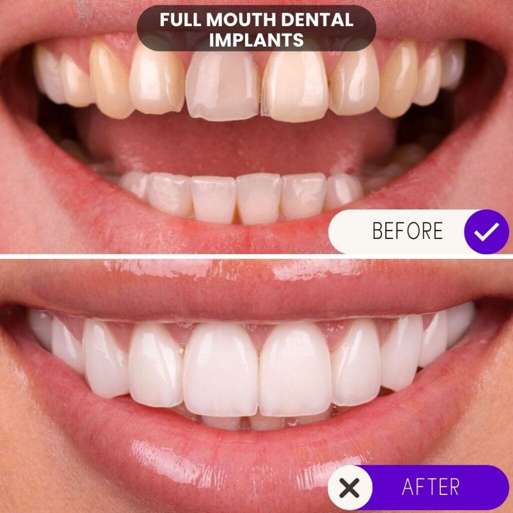 Before and after full mouth dental implants - functional and aesthetic improvements.