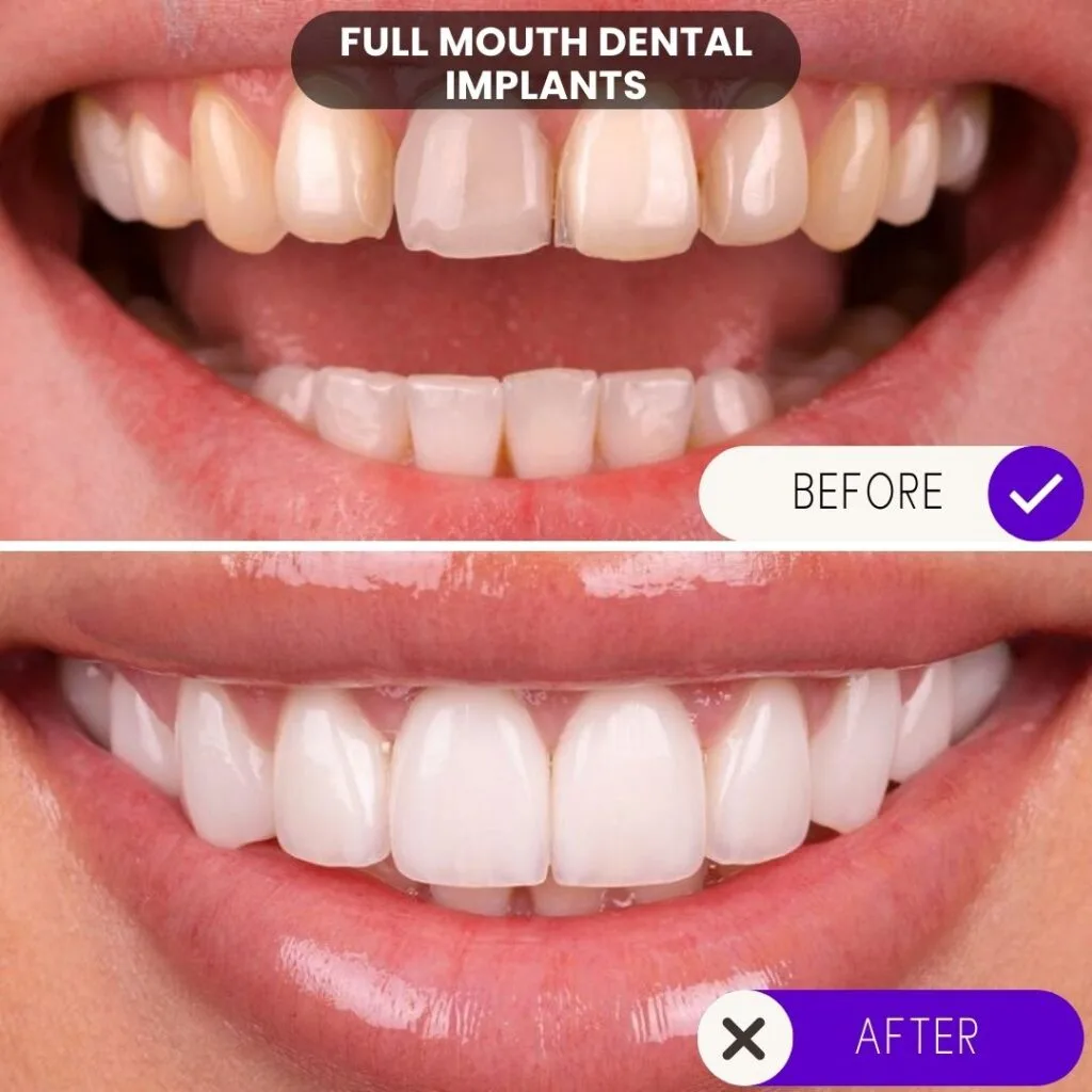Antes y después de implantes dentales de boca completa: mejoras funcionales y estéticas.