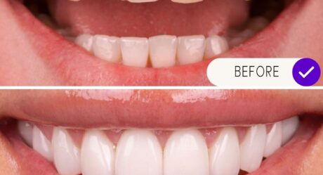 Full Mouth Dental Implants in Turkey: Affordable Package Deals Explained