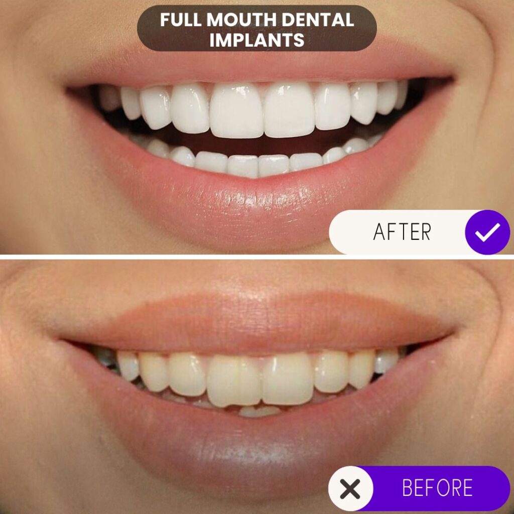 Full dental implants upper jaw replacement before and after.