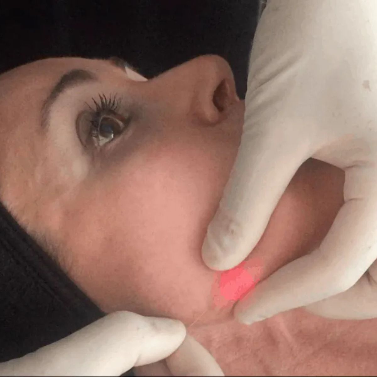 Endolift procedure performed on the facial area.