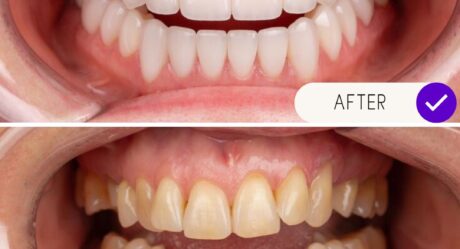 The Ultimate Guide to Full Mouth Dental Implants Turkey Package Deals