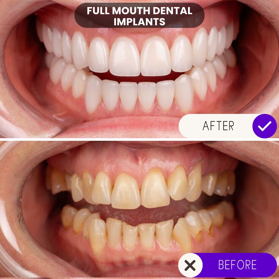 Patient smile restoration with full dental implants before and after