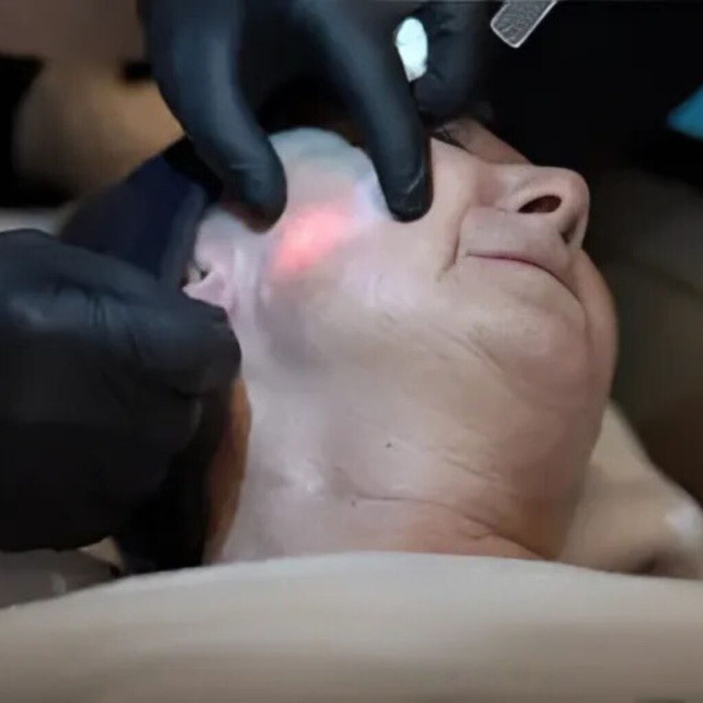 Endolift procedure performed on the facial area.