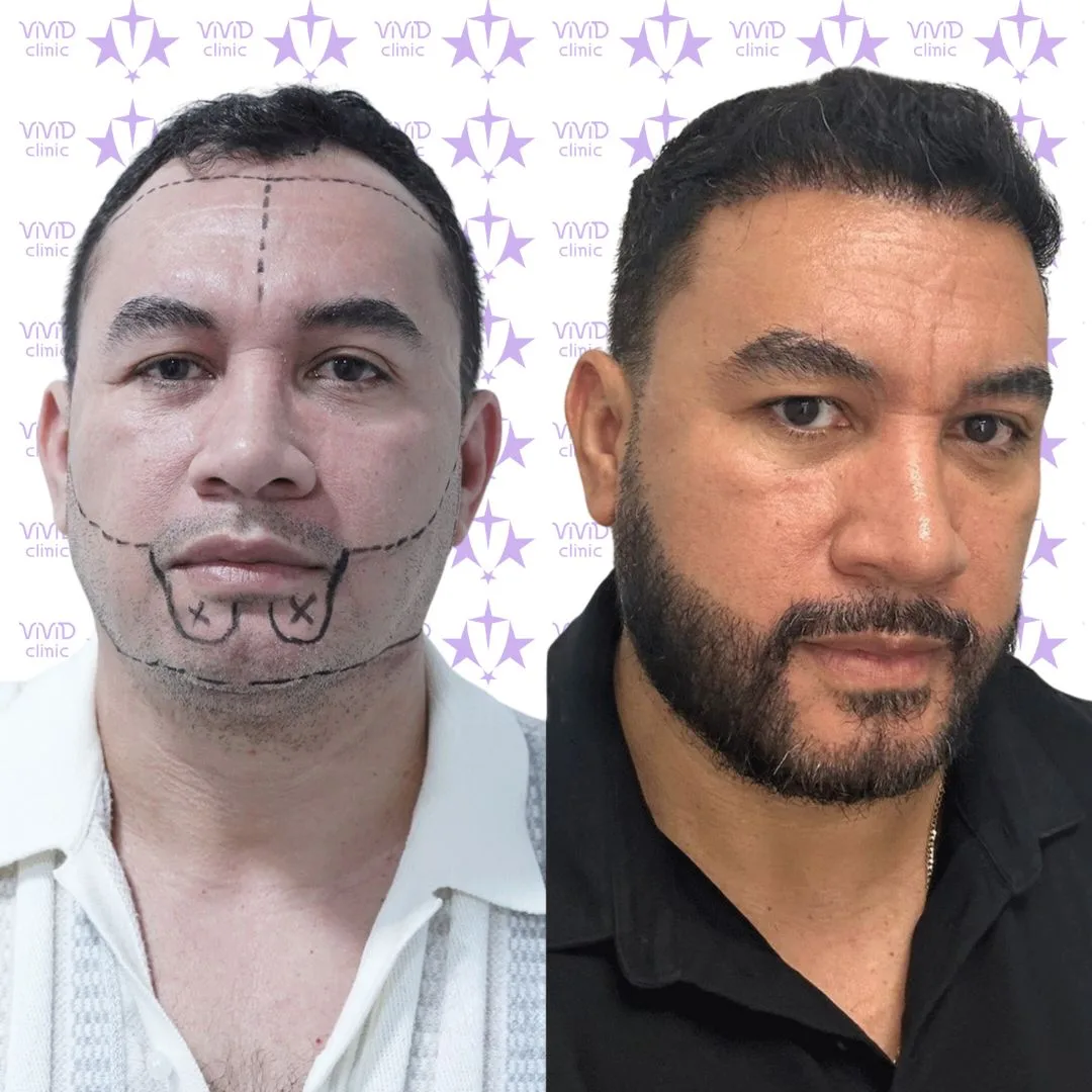 Hombre con marcas dibujadas en la cara para un trasplante de barba planificado, junto al mismo hombre con una barba más poblada después.
