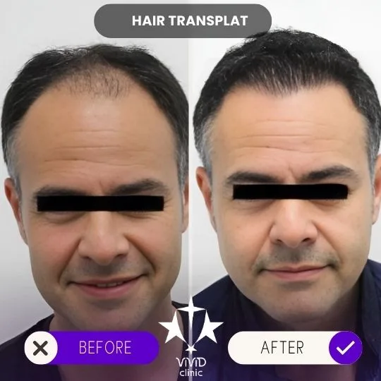 Hombre con entradas antes y una línea de cabello más baja y poblada después; ojos cubiertos por privacidad.