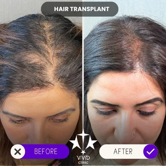Kanada Saç Ekimi Maliyeti | Vivid Clinic İstanbul, Türkiye'de Saç Ekimi Yolculuğu