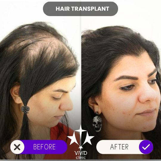 Trasplante capilar en Vivid Clinic Estambul, Turquía