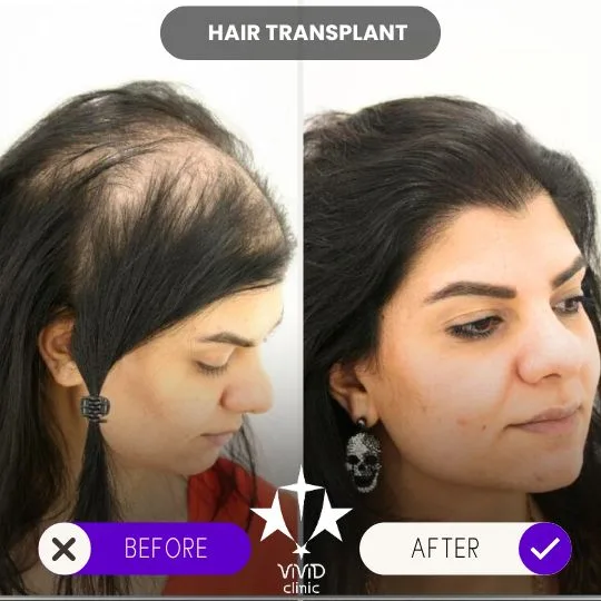 Mujer con cabello fino en las sienes y los lados antes del tratamiento, y con cabello más abundante después.
