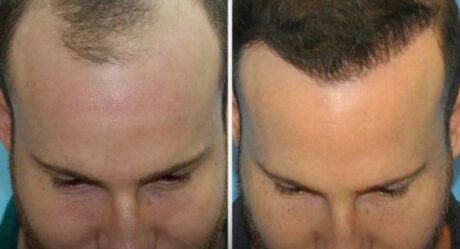 Методы пересадки волос: 7 удивительных техник, которые помогут вернуть уверенность в себе