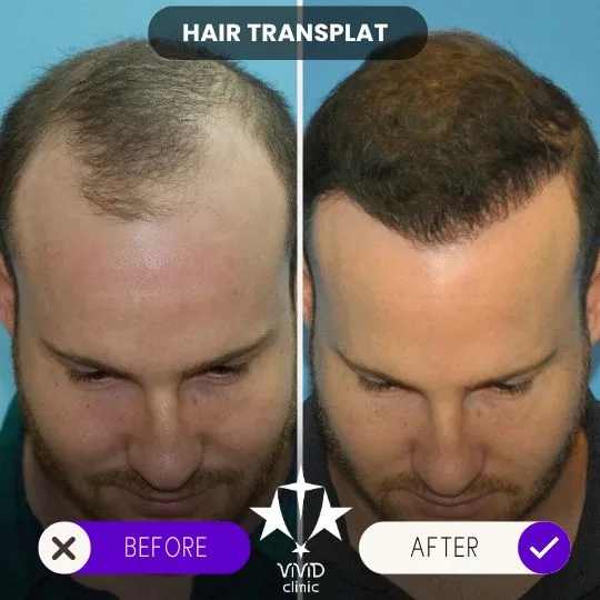 Vivid Clinic İstanbul, Türkiye'de saç ekimi yolculuğu yöntemleri