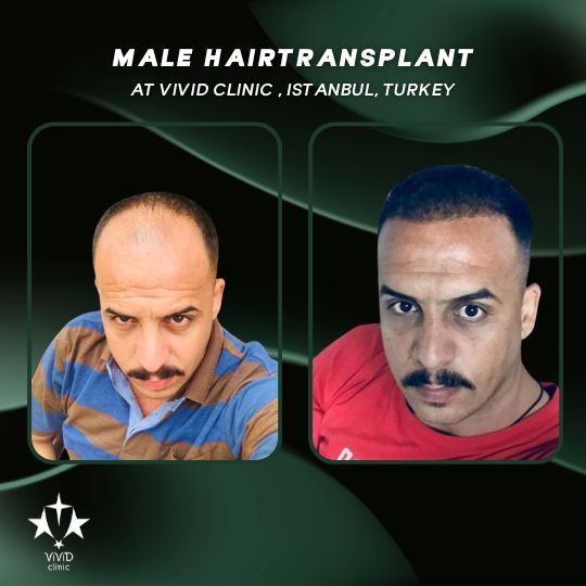 Hair Transplant Journey at Vivid Clinic Istanbul, Turkey