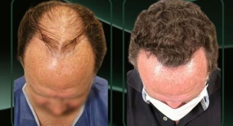 7 Key Insights on Canada Hair Transplant Cost You Can’t Miss