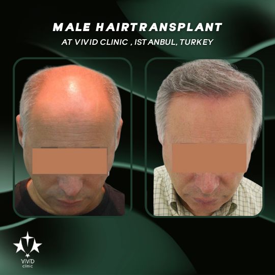 Hair Transplant Journey at Vivid Clinic Istanbul, Turkey