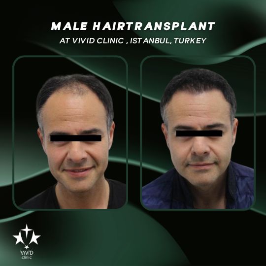 Hair Transplant Journey at Vivid Clinic Istanbul, Turkey