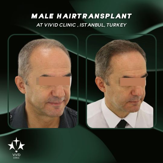 Hair Transplant Journey at Vivid Clinic Istanbul, Turkey