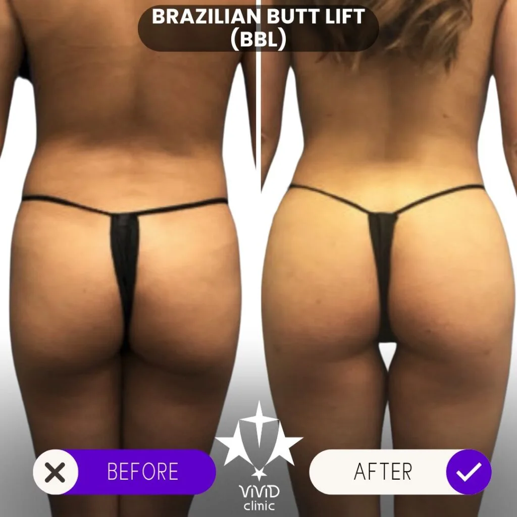 BBL surgery in Istanbul has gained global popularity for its affordability, expert surgeons, and outstanding results, making it the top destination for those seeking a Brazilian Butt Lift. Istanbul, Turkey, has emerged as a global hotspot for BBL surgery due to its skilled surgeons, state-of-the-art facilities, and affordable prices. If you’re considering this life-changing procedure, here’s everything you need to know.