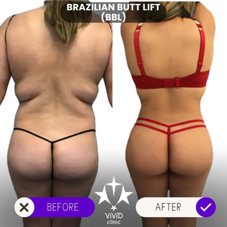 What Does BBL Stand For? Rear-view before and after composite of a BBL, showing a change in waist and buttock contour