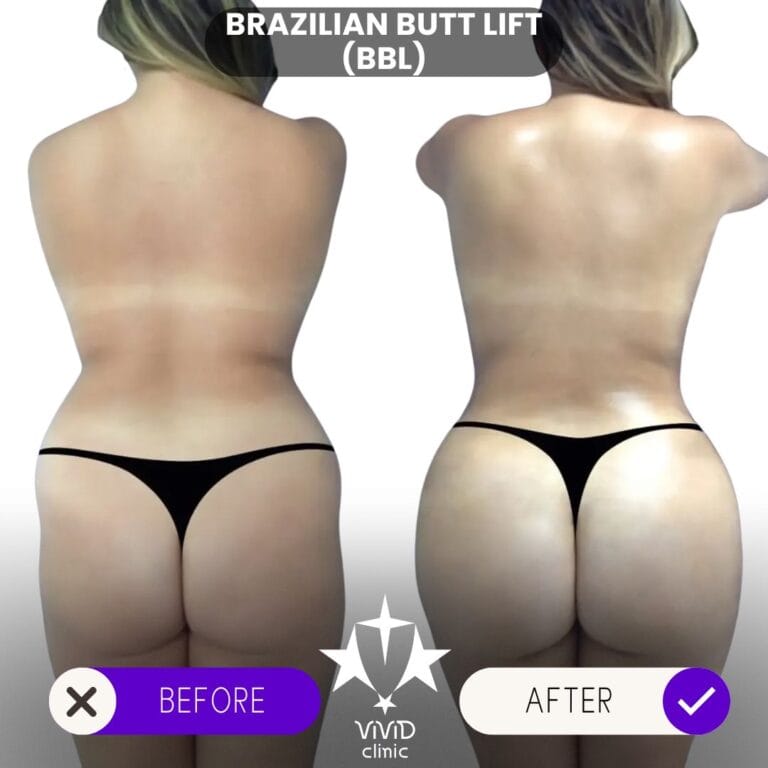 What Does BBL Stand For? Close-up rear-view before and after composite of a BBL