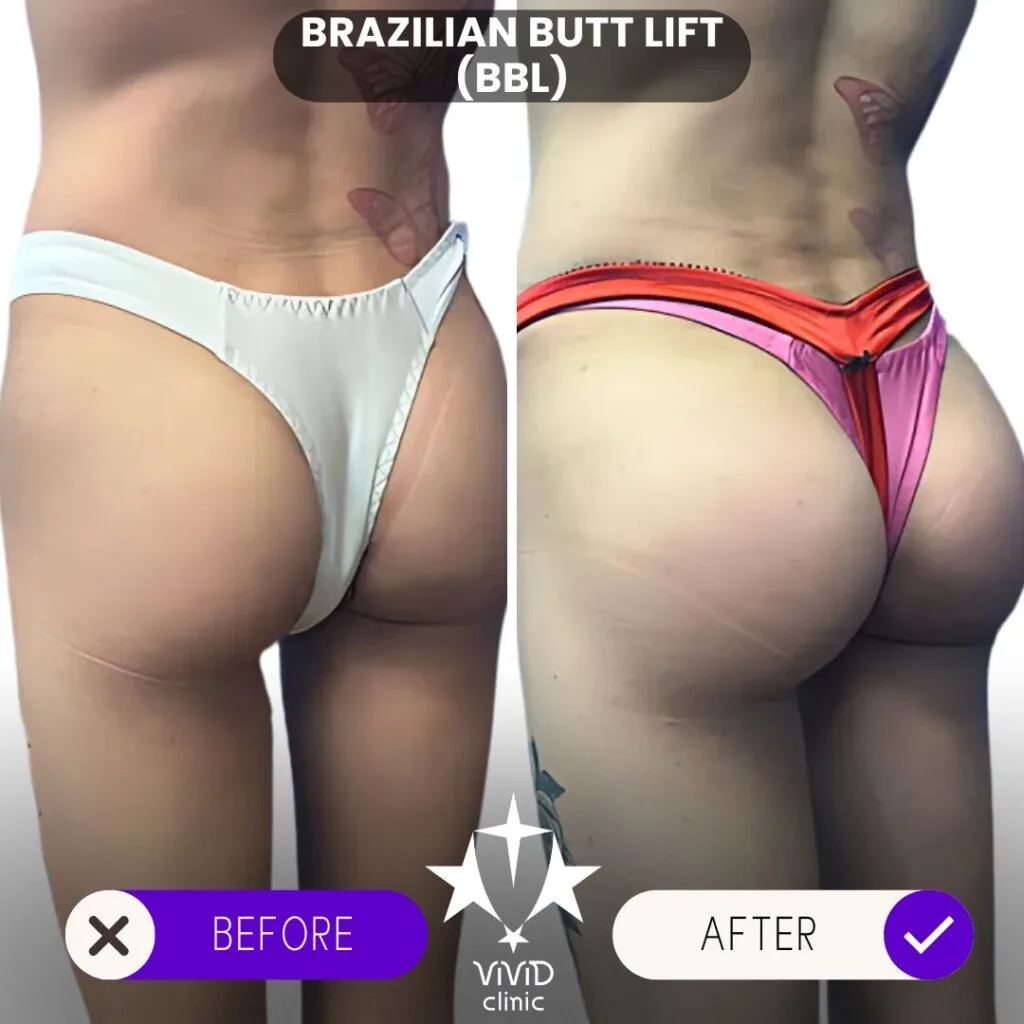 BBL surgery in Istanbul has gained global popularity for its affordability, expert surgeons, and outstanding results, making it the top destination for those seeking a Brazilian Butt Lift. Istanbul, Turkey, has emerged as a global hotspot for BBL surgery due to its skilled surgeons, state-of-the-art facilities, and affordable prices. If you’re considering this life-changing procedure, here’s everything you need to know.