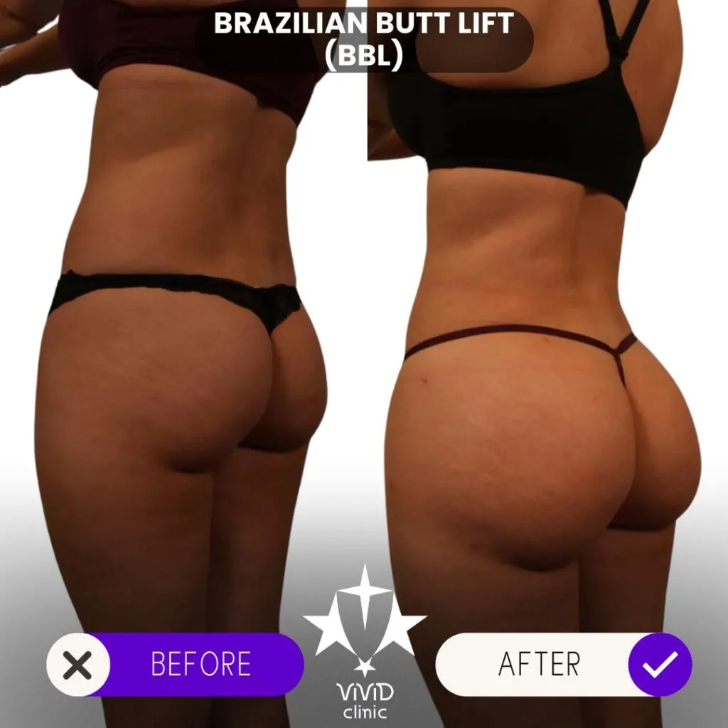 Antes y después de la cirugía BBL en Vivid Clinic mostrando una forma natural y más completa.