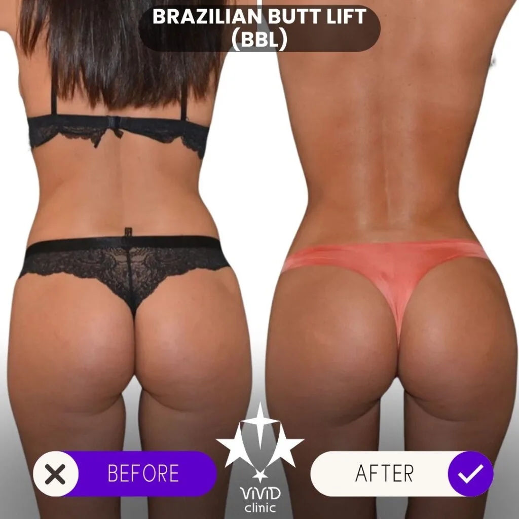 BBL surgery in Istanbul has gained global popularity for its affordability, expert surgeons, and outstanding results, making it the top destination for those seeking a Brazilian Butt Lift. Istanbul, Turkey, has emerged as a global hotspot for BBL surgery due to its skilled surgeons, state-of-the-art facilities, and affordable prices. If you’re considering this life-changing procedure, here’s everything you need to know.