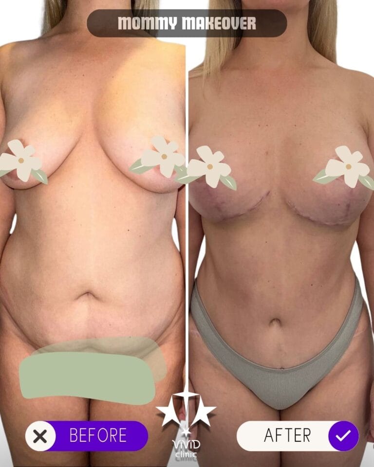Mommy Makeover in Turkey Before and after composite of a mommy makeover including breast lift and tummy tuck, with visible breast-lift scars