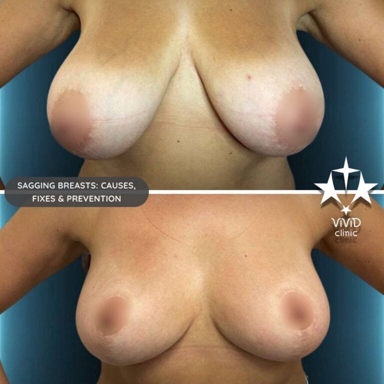 Before and after results of anchor technique breast lift surgery for severe sagging