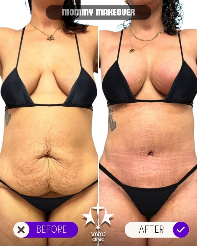 Before and after full-body mommy makeover results at Vivid Clinic in Istanbul