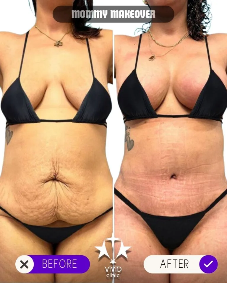 Vorher- und Nachher-Ergebnisse des Ganzkörper-Mommy-Makeovers in der Vivid Clinic in Istanbul
