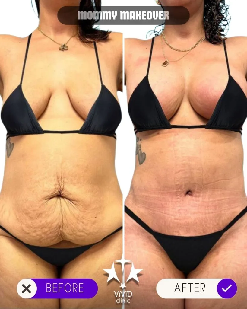 Resultados del antes y el después de un cambio de imagen corporal completo para mamás en la Clínica Vivid de Estambul