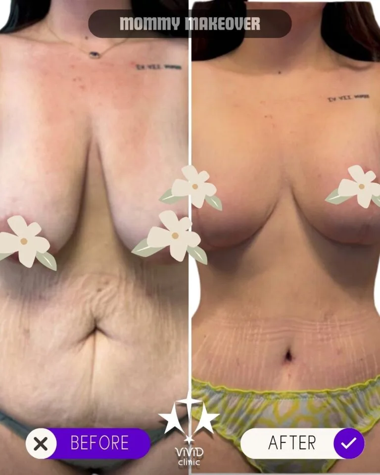 Vorher-Nachher-Ergebnisse eines Mommy Makeover BBL in der Vivid Clinic Türkei
