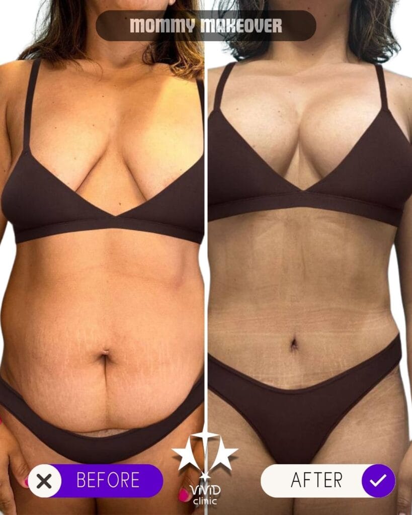 Mommy Makeover in Turkey, Istanbul: Cost, Procedures & Top Clinics Before and after mommy makeover tummy tuck and liposuction at Vivid Clinic Istanbul