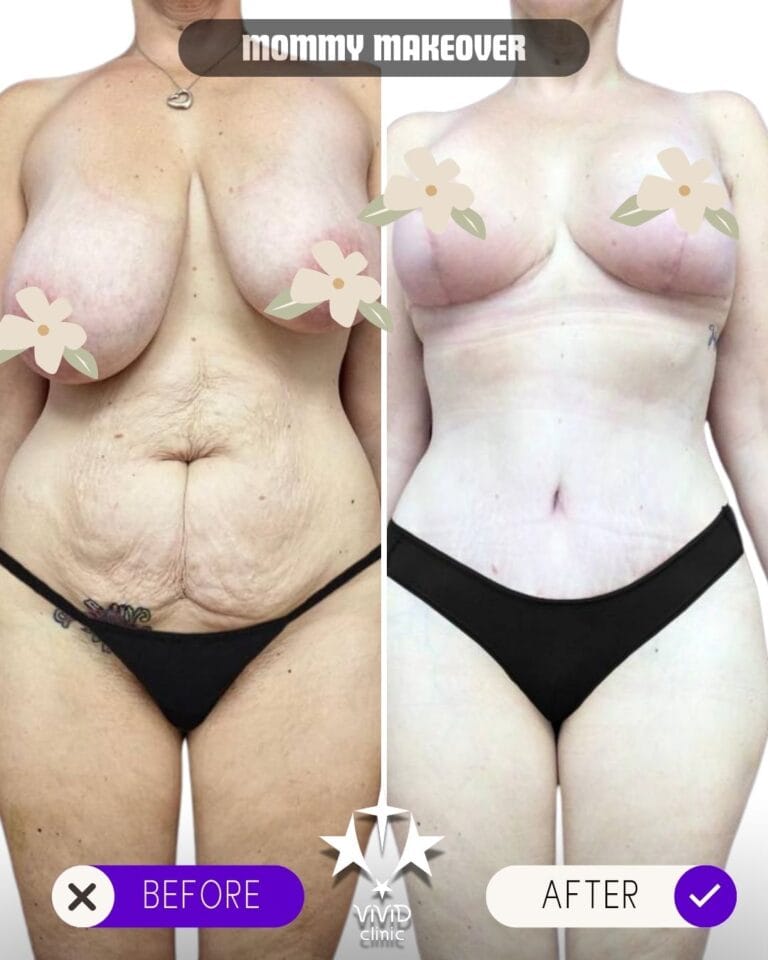 Before and after mommy makeover breast lift and augmentation results at Vivid Clinic Turkey