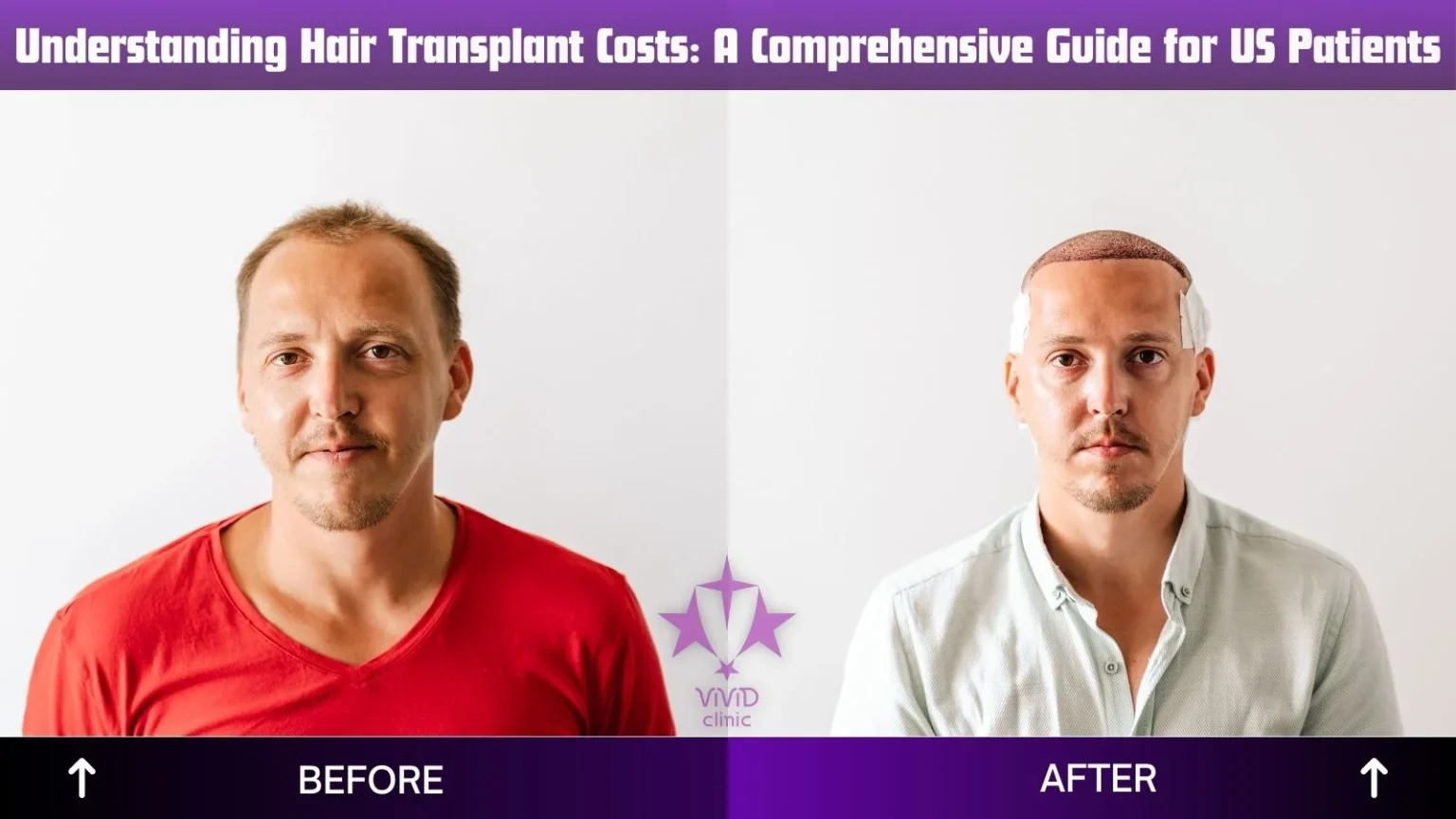 hair transplant cost 2026 | Dramatic transformation with 4,000 grafts – Real patient results