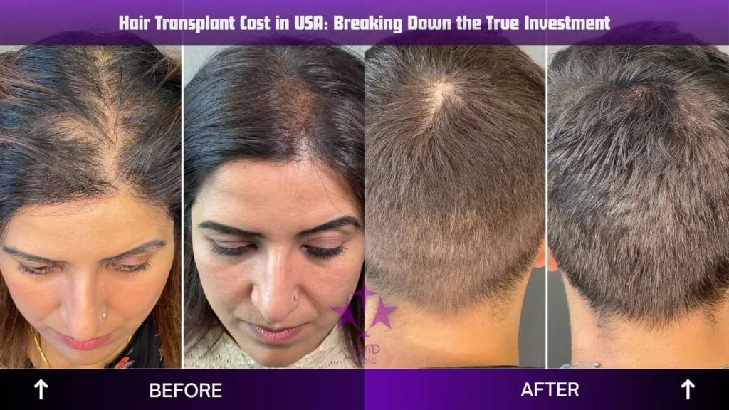 стоимость пересадки волос в США