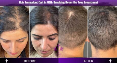 تكلفة زراعة الشعر في الولايات المتحدة الأمريكية: تحليل الاستثمار الحقيقي