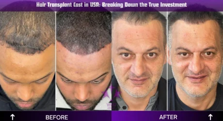 Vergleich der Kosten für Haartransplantationen in den USA: Warum Vivid Clinic mehr für weniger Geld bietet
