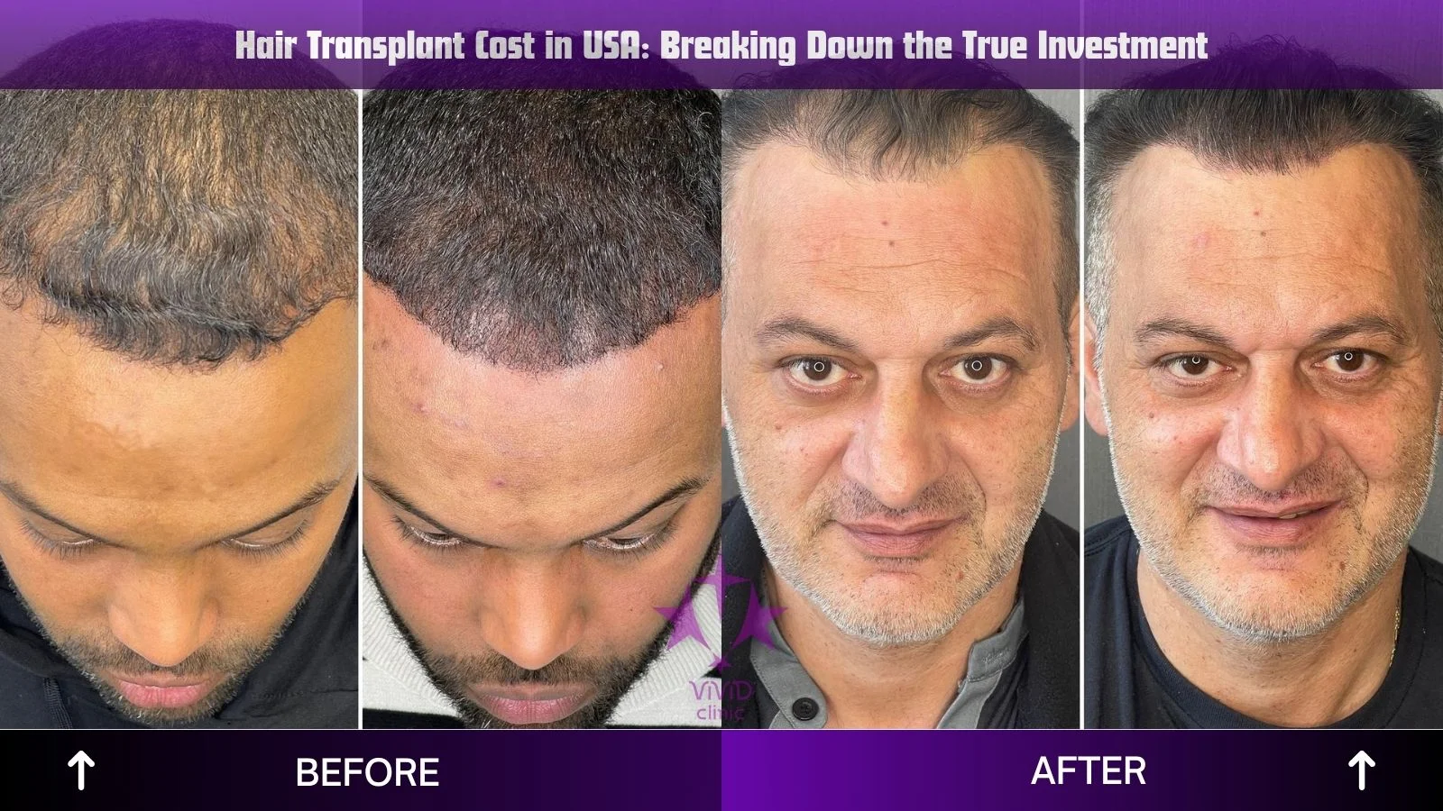 Результат натуральной пересадки волос в Стамбуле