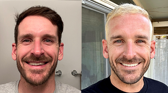 Invisalign overbite before and after treatment result