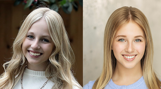 Invisalign before and after Istanbul smile design