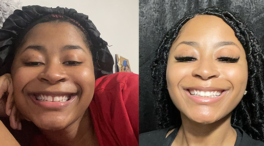 Invisalign before and after rubber bands treatment