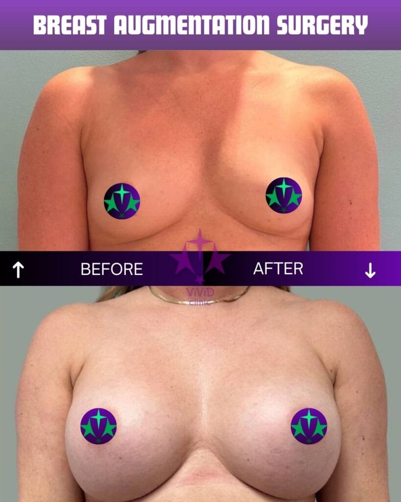 breast augmentation before and after comparison