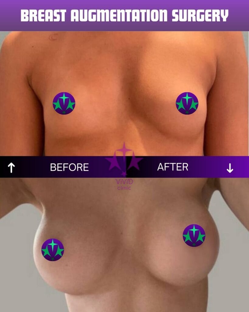 breast augmentation visual results