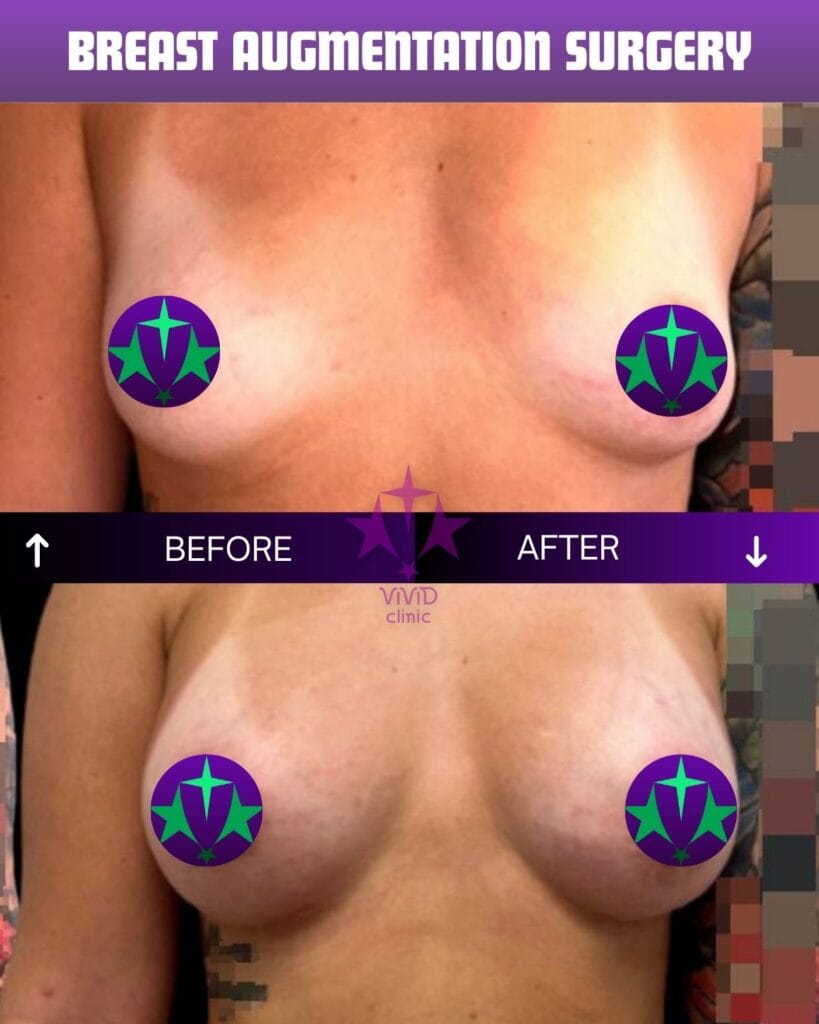 breast augmentation surgery before and after