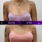 Before and after breast augmentation surgeon performed at Vivid Clinic