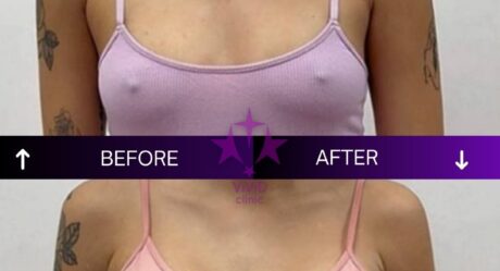 Хирург за уголемяване на гърдите: 7 основни тайни за избор на идеалния специалист в Истанбул